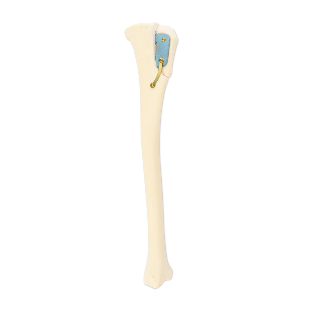 SPP Patella Luxation System
