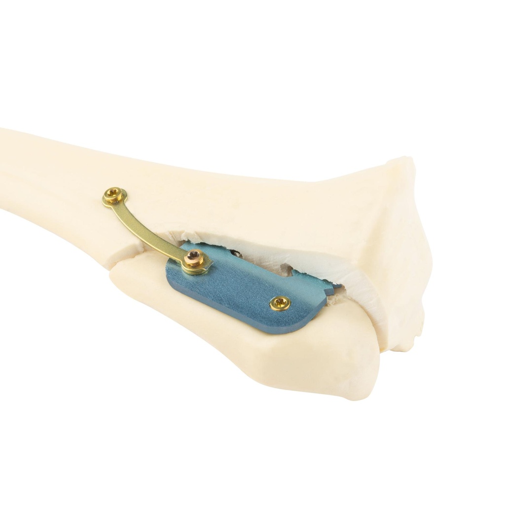 SPP Patella Luxation System