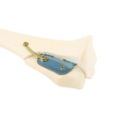 SPP Patella Luxation System